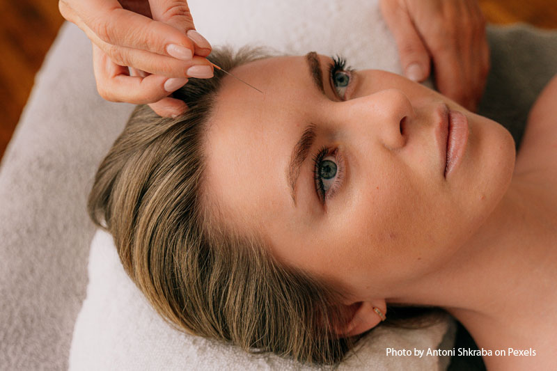 How to Prepare for Acupuncture Treatments